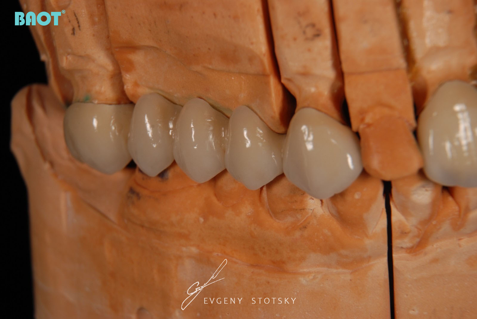 стоматологический керамический порошок для зуботехнической лаборатории