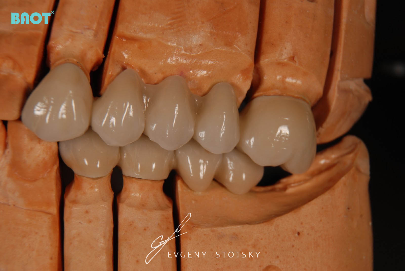 Использование керамики для зубных протезов
