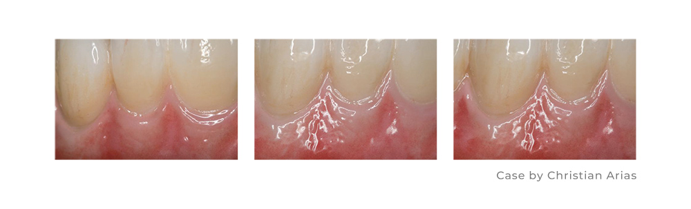Zirconia Ceramic Restoration Dental Stain Glaze Paste