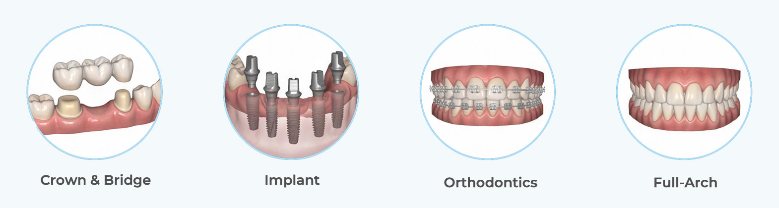 BAOT MS02 intraoral scanner for crown and bridge, implant, orthodontic, and full-arch applications